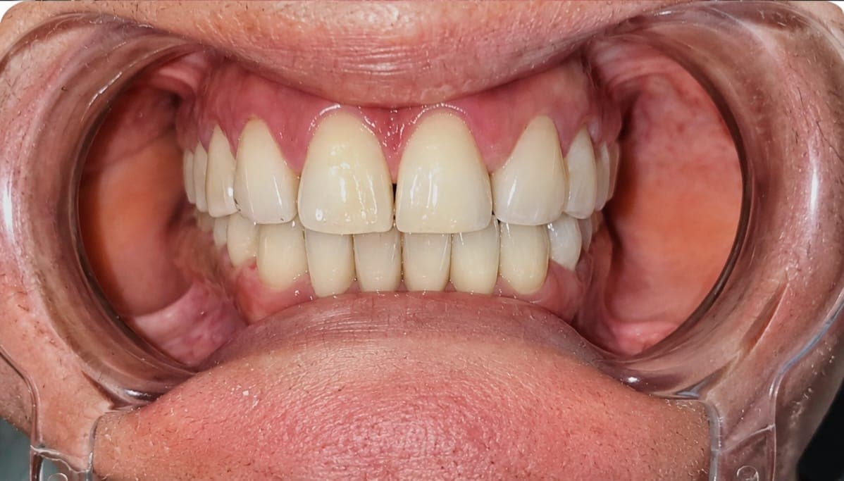 After treatment