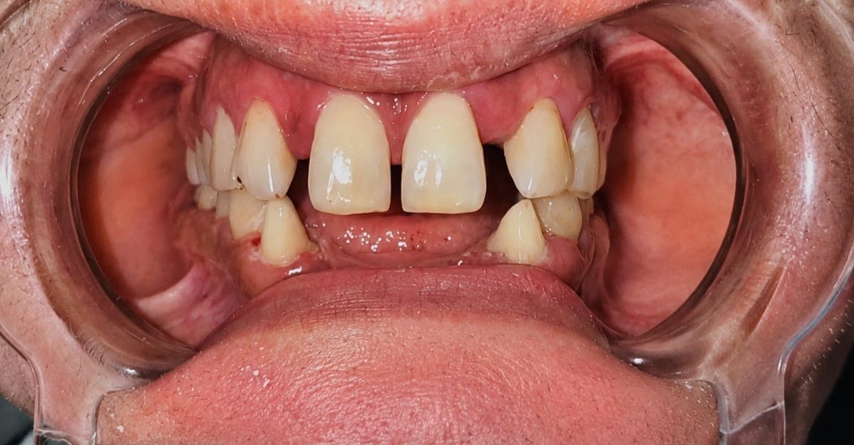 Before treatment